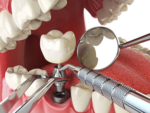 Best Emergency Broken Tooth Repair in West Bend, WI